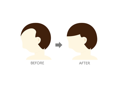 親和クリニックのMIRAI法|切らない自毛植毛で自然な若返り